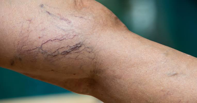 Varicose Veins